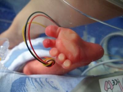 Optimal Position for Preemies Must Provide Feeling of Containment